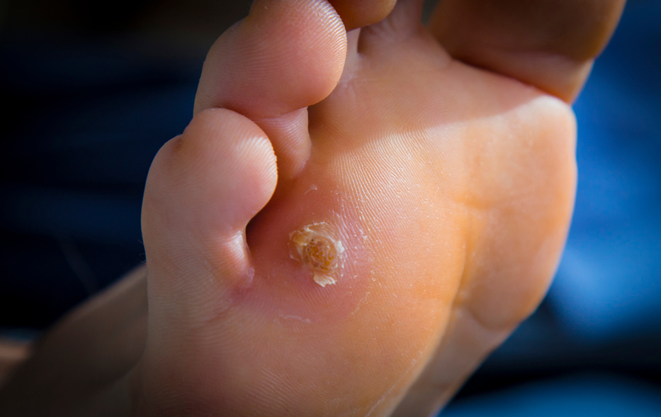 Calluses on foot