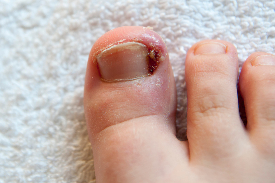 Child foot: onychocryptosis - an ingrown toenail