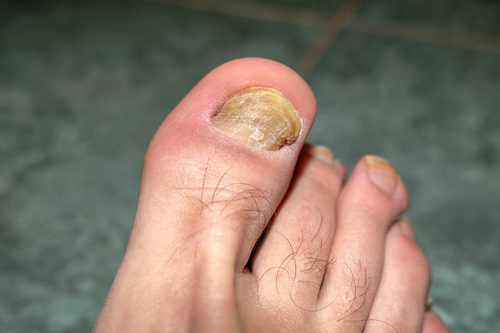 Human fingers with sick onycho mycosis nails,dermatologic healthcare,medical